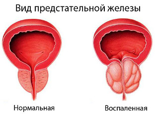 простата нормальная и увеличенная