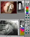 Радиовизиография зубов