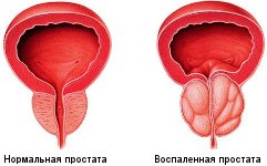 Состояния простаты