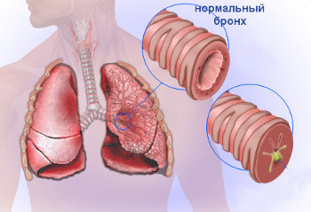 Бронхит