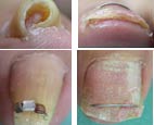 ingrown_nail.jpg