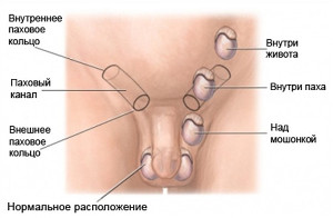 крипторхизм