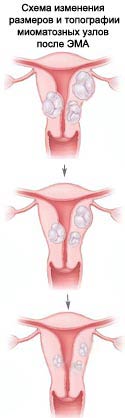 Миома после ЭМА