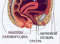 недержание мочи у женщин