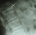 остеопороз позвоночника