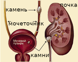 Почечная колика болит правый бок