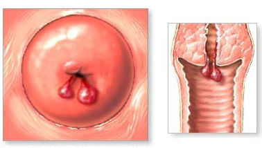 Заболевания шейки матки - полипы