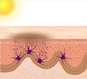 Кожа, поврежденная солнцем