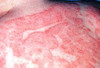 atopich-dermatit.jpg