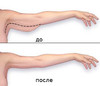 brakhioplastika.jpg