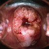 cervicalcancer2.jpg