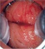 cervicit-hronich.jpg