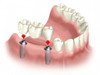 implant-most.jpg