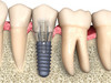 implant-oslozhnenija.jpg