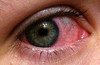 infe-eye.jpg