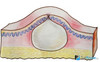 lipoma.jpg
