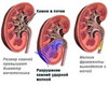 литотрипсия дистанционная