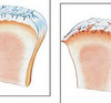 osteoartoz1.jpg