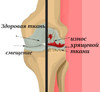 osteoartroz.jpg