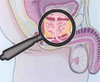 prostatit-uveli.jpg