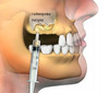 sinus-lifting.jpg