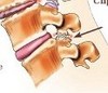 spondiliartroz-small.jpg