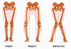 valgus-narus.jpg
