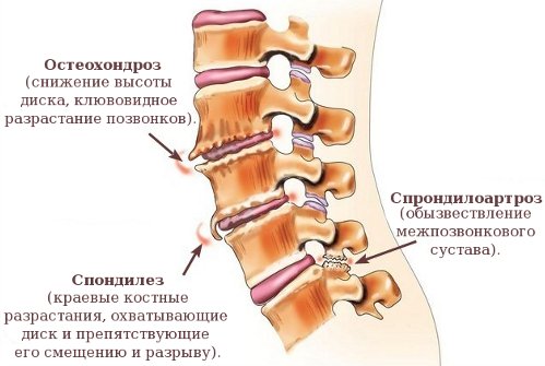 Спондилоартроз, остеохондроз и спондилез